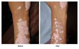 Vitiligo Disease Cure Treatment In Kerala