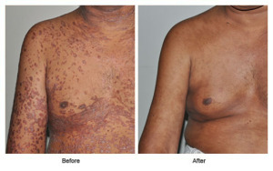 psoriasis treatment