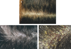 dandruff treatment