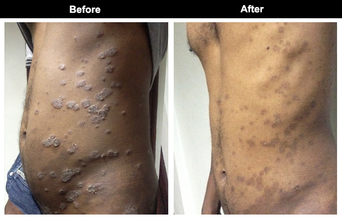 psoriasis treatment