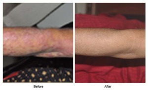 urticaria treatment