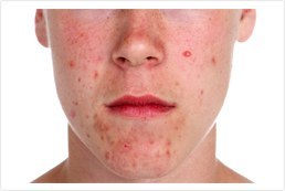 acne treatment in kerala