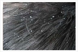 ayurvedic dandruff treatment kerala