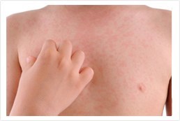 ayurvedic urticaria treatment kerala