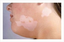 ayurvedic vitiligo treatment kerala