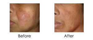 Dermatitis Treatment before after image