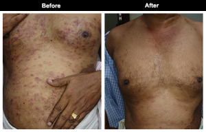 Dermatitis-on-Body-Treatment