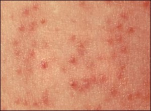 	scabies treatment