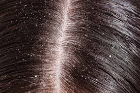 ayurvedic dandruff treatment