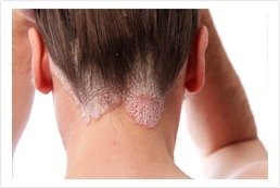 ayurvedic psoriasis treatment kerala