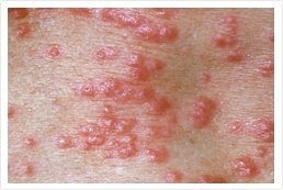 ayurvedic scabies treatment kerala